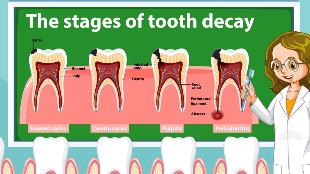 Tooth Decay Gentle Dental Care Sterling VA